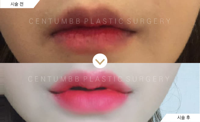 CENTUMBB PLASTIC SURGERY & DERMATOLOGY 案例
