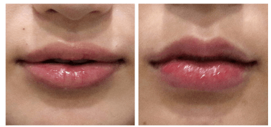 LIZON CLINIC(HONGDAE) 案例